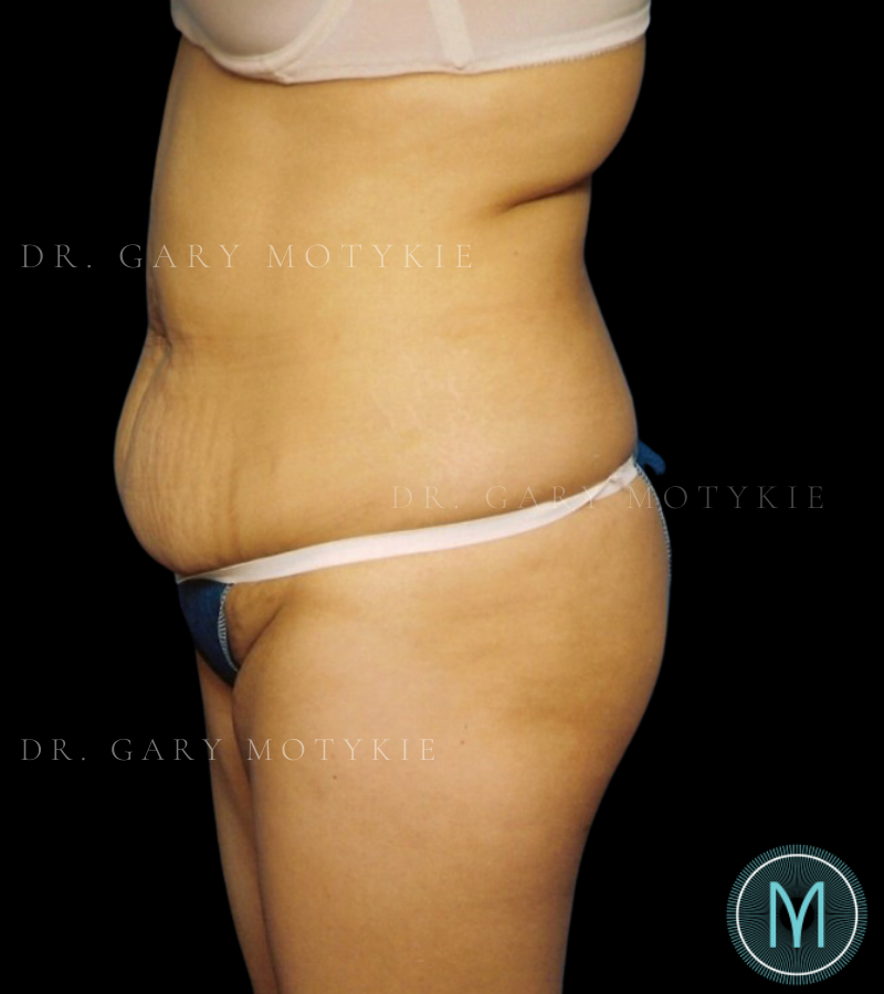Before thumbnail for Case 1 Tummy Tuck Before and After Photos