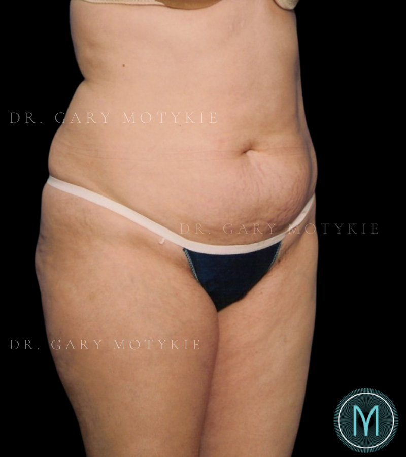 Before thumbnail for Case 2 Tummy Tuck Before and After Photos