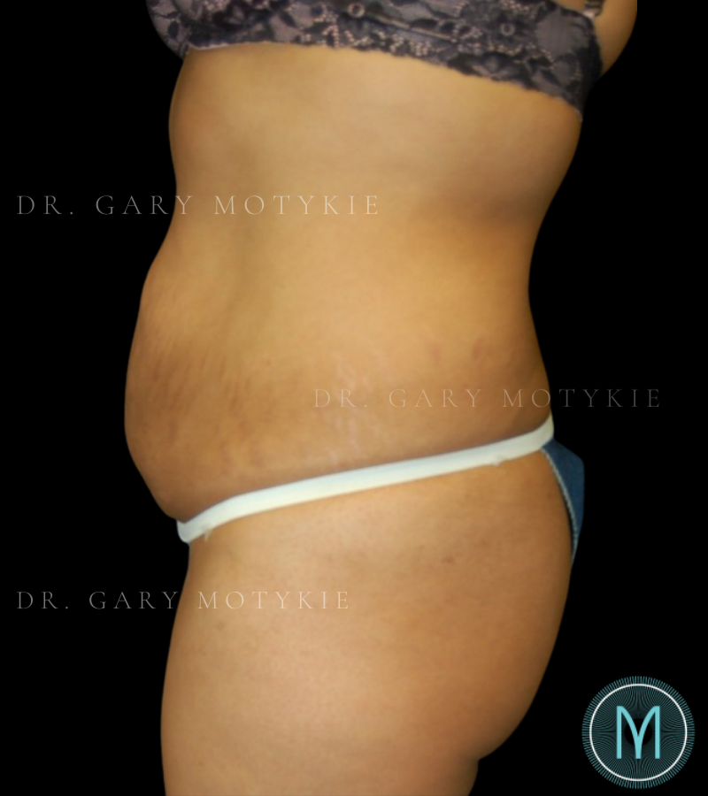 Before thumbnail for Case 3 Tummy Tuck Before and After Photos