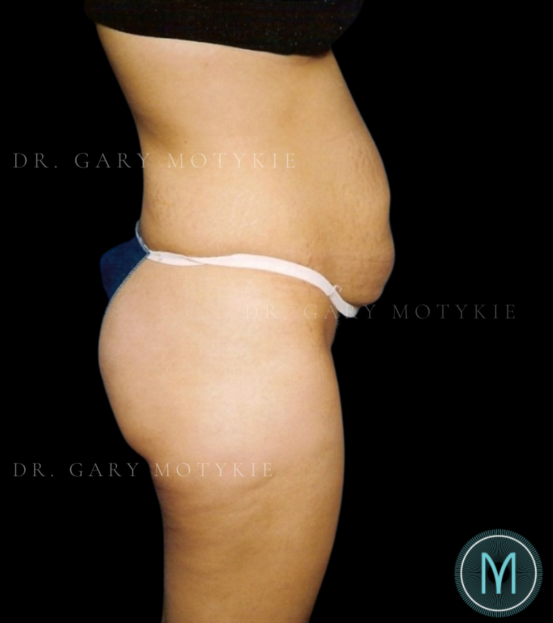 Before thumbnail for Case 4 Tummy Tuck Before and After Photos