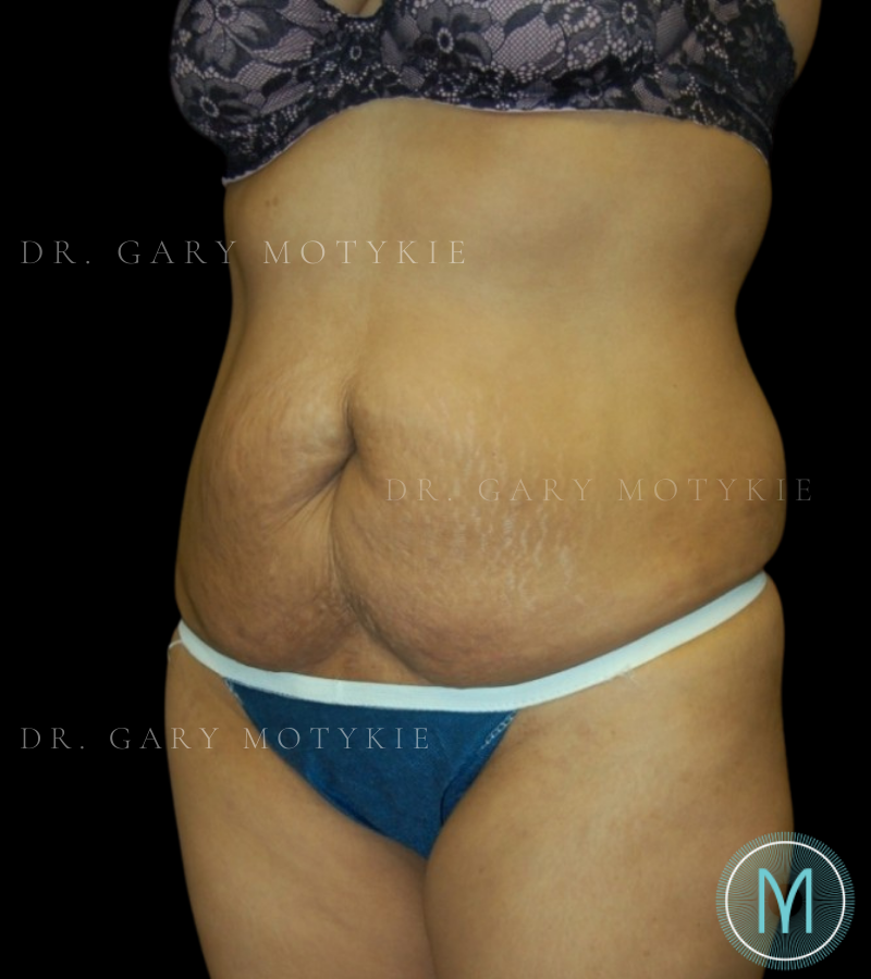 Before thumbnail for Case 3 Tummy Tuck Before and After Photos