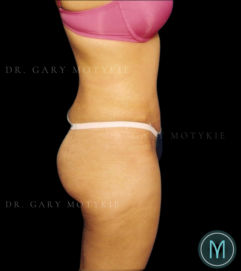After thumbnail for Case 4 Tummy Tuck Before and After Photos