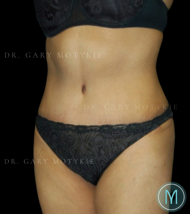 After thumbnail for Case 3 Tummy Tuck Before and After Photos