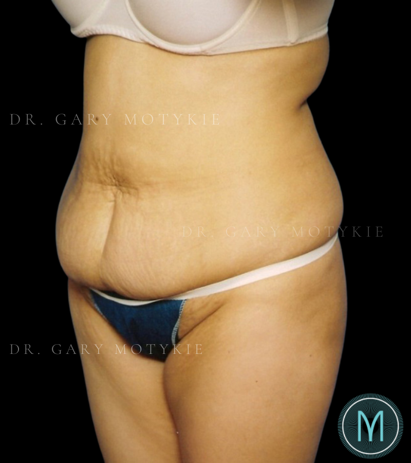 Before thumbnail for Case 1 Tummy Tuck Before and After Photos