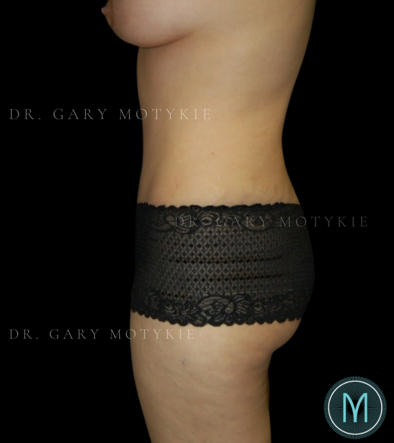 After thumbnail for Case 5 Tummy Tuck Before and After Photos