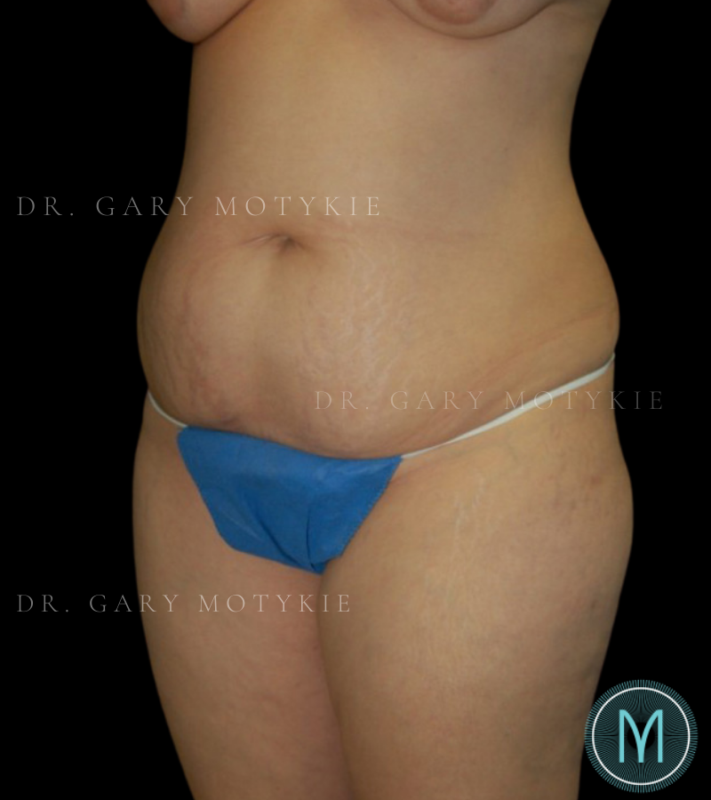 Before thumbnail for Case 5 Tummy Tuck Before and After Photos