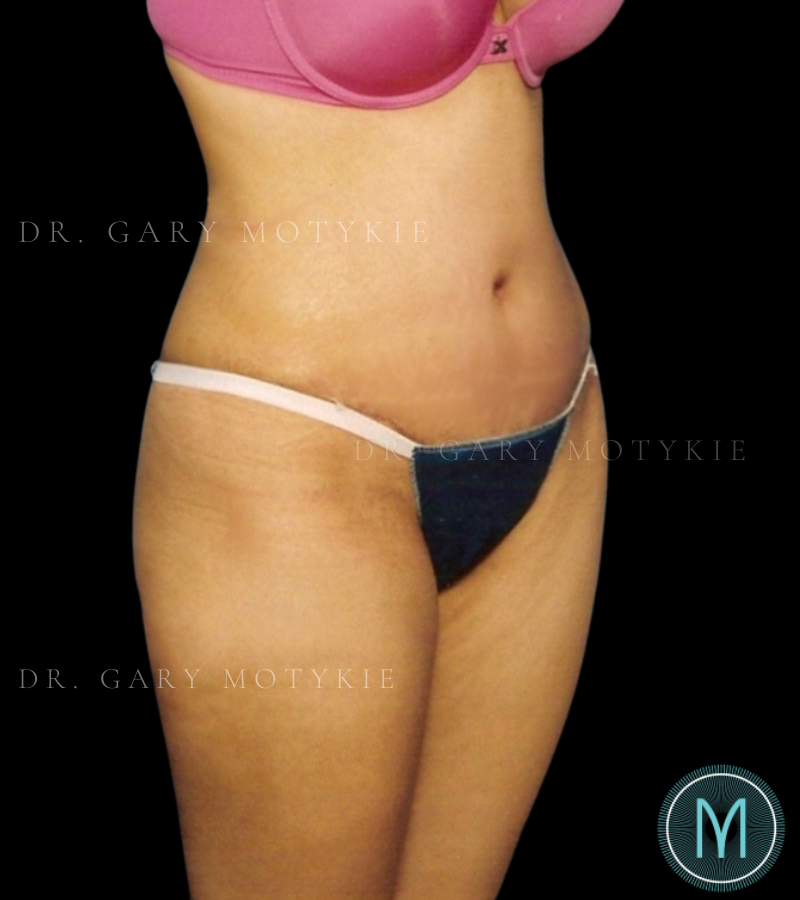 After thumbnail for Case 4 Tummy Tuck Before and After Photos
