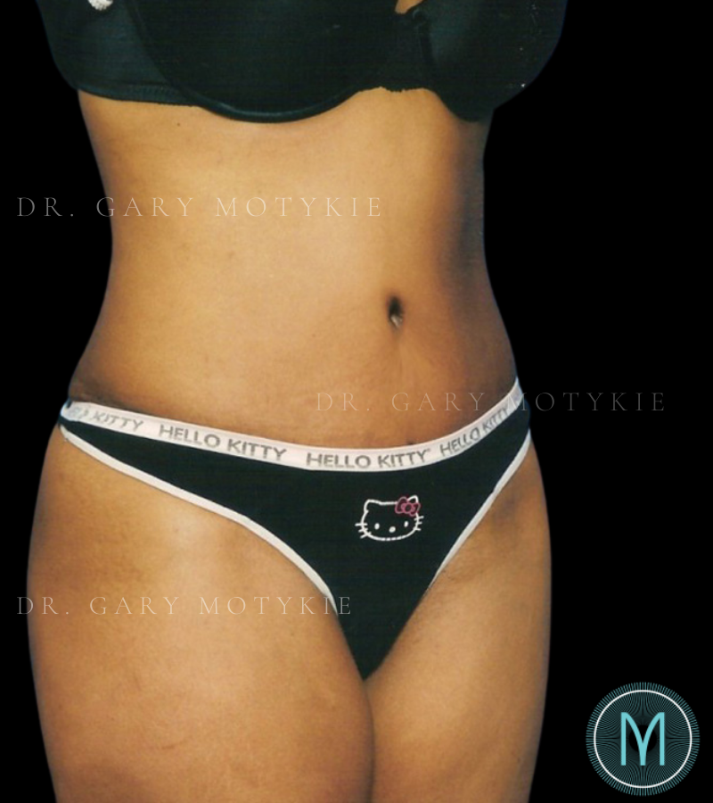 After thumbnail for Case 6 Tummy Tuck Before and After Photos