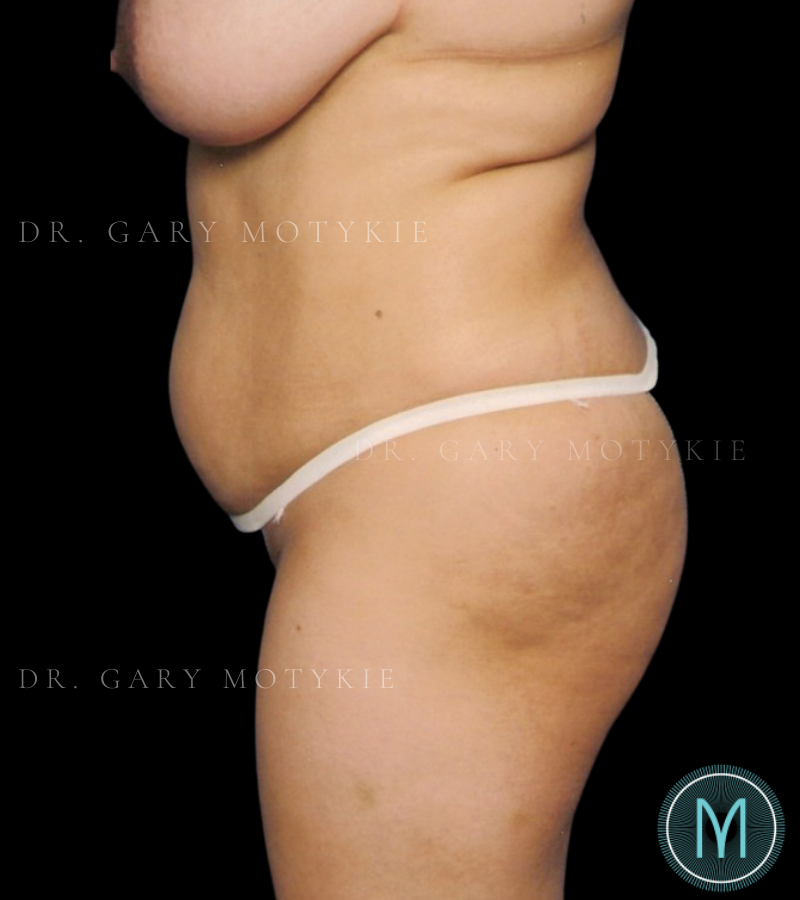 Before thumbnail for Case 11 Tummy Tuck Before and After Photos