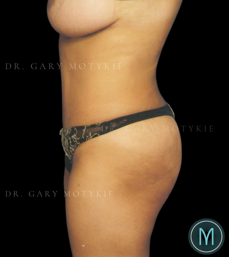 After thumbnail for Case 11 Tummy Tuck Before and After Photos