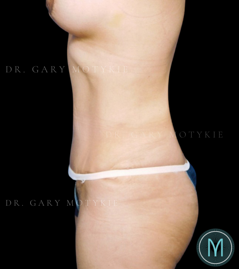After thumbnail for Case 13 Tummy Tuck Before and After Photos