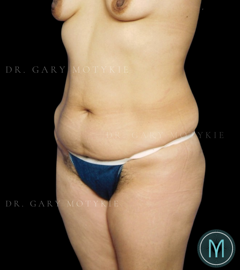 Before thumbnail for Case 13 Tummy Tuck Before and After Photos