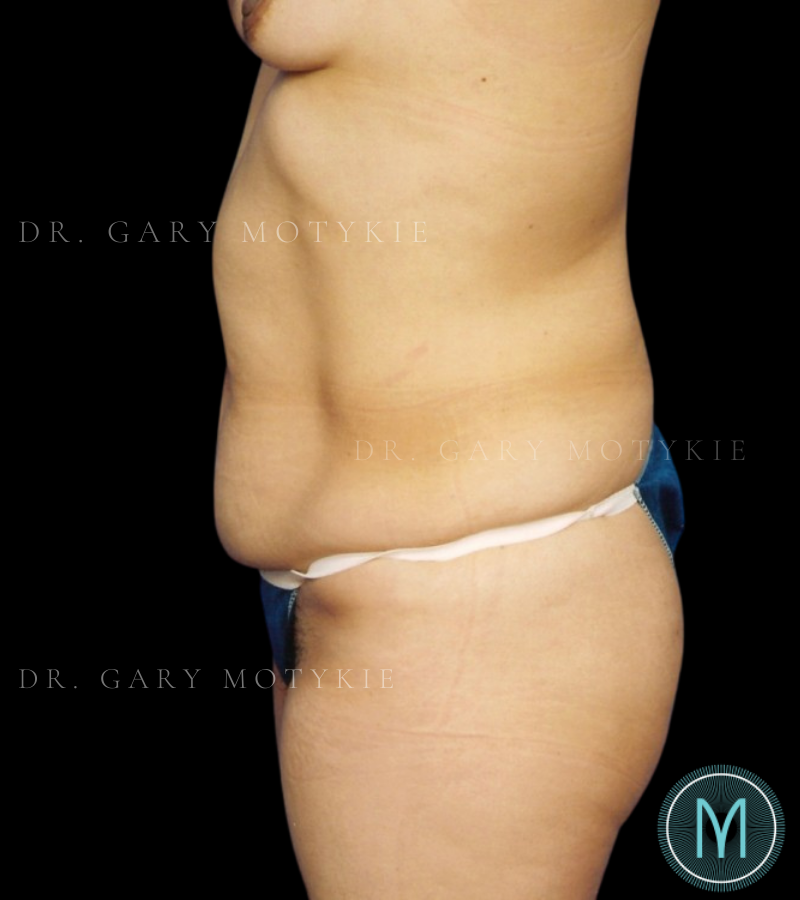 Before thumbnail for Case 13 Tummy Tuck Before and After Photos