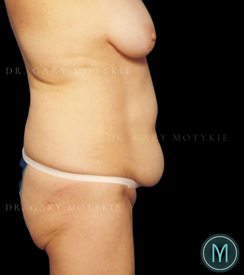 Before thumbnail for Case 14 Tummy Tuck Before and After Photos