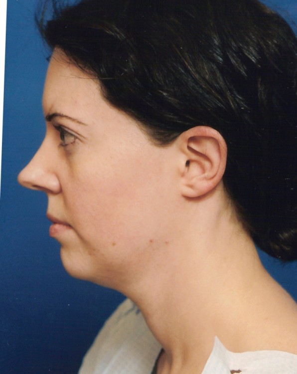 Before thumbnail for Case 5 Neck Liposuction Before and After Photos