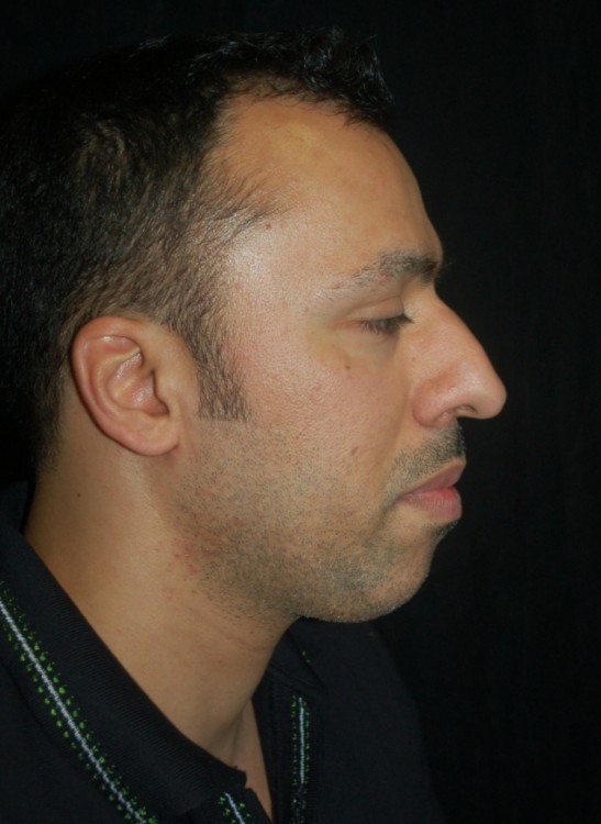 Before thumbnail for Case 7 Profile Balancing (Chin & Rhinoplasty) Before and After Photos
