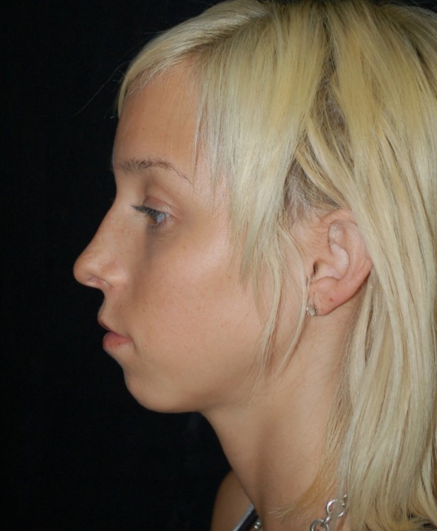 Before thumbnail for Case 8 Profile Balancing (Chin & Rhinoplasty) Before and After Photos