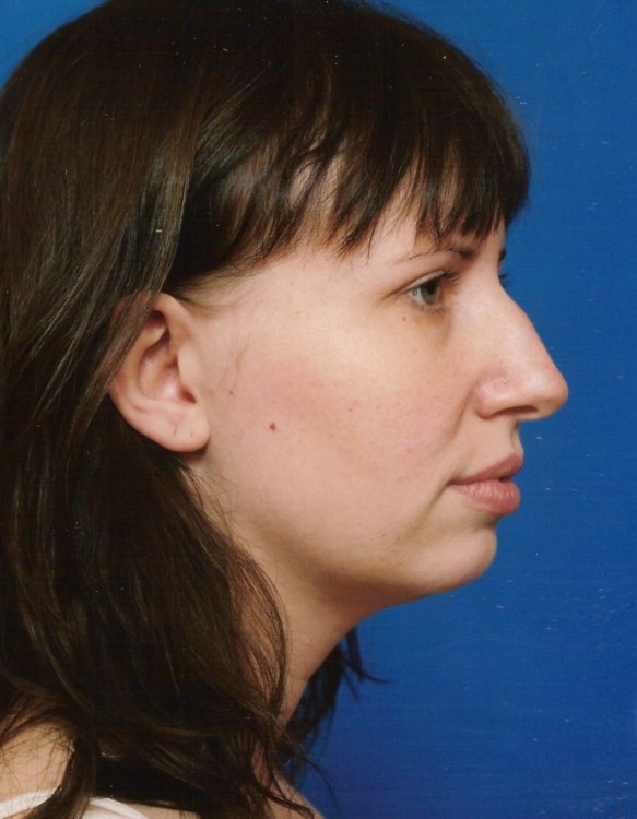 Before thumbnail for Case 10 Profile Balancing (Chin & Rhinoplasty) Before and After Photos