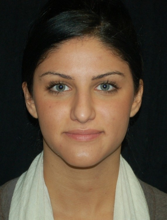Before thumbnail for Case 3 Rhinoplasty Before and After Photos