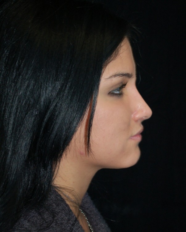 After thumbnail for Case 3 Rhinoplasty Before and After Photos
