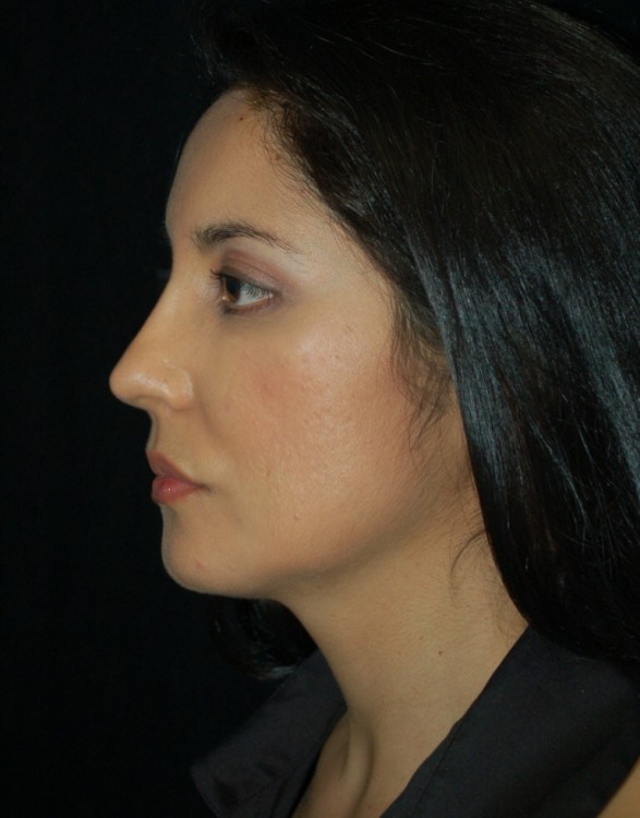 After thumbnail for Case 19 Rhinoplasty Before and After Photos
