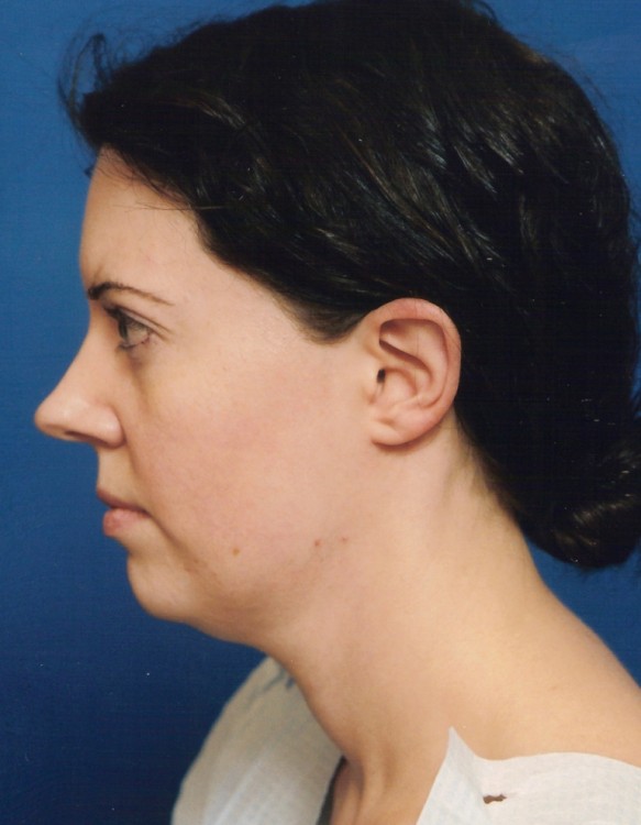 Before thumbnail for Case 20 Rhinoplasty Before and After Photos