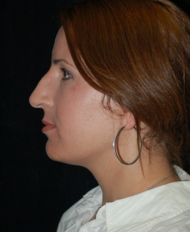 Before thumbnail for Case 29 Rhinoplasty Before and After Photos