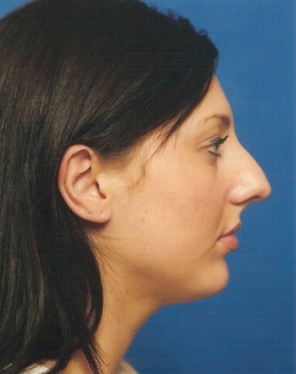 Before thumbnail for Case 30 Rhinoplasty Before and After Photos