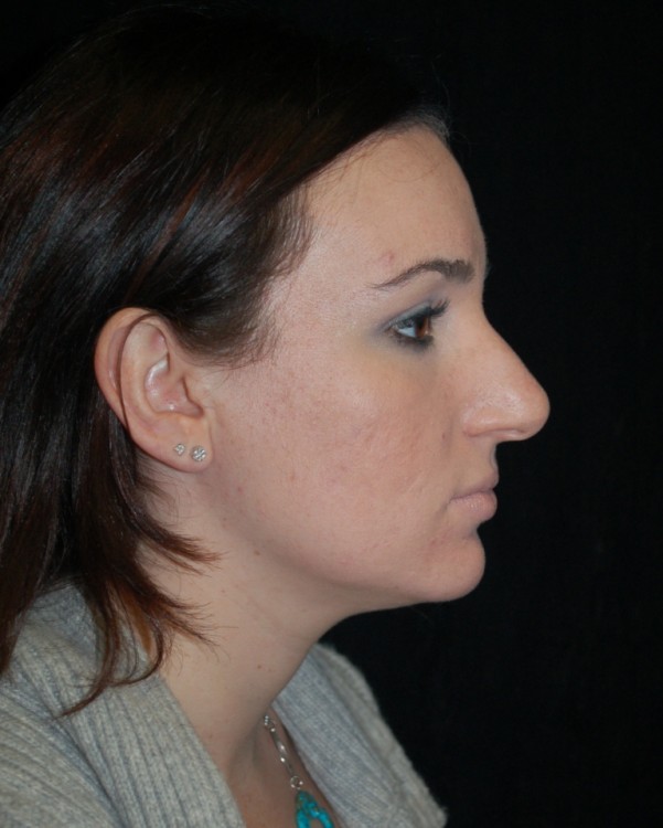 Before thumbnail for Case 32 Rhinoplasty Before and After Photos
