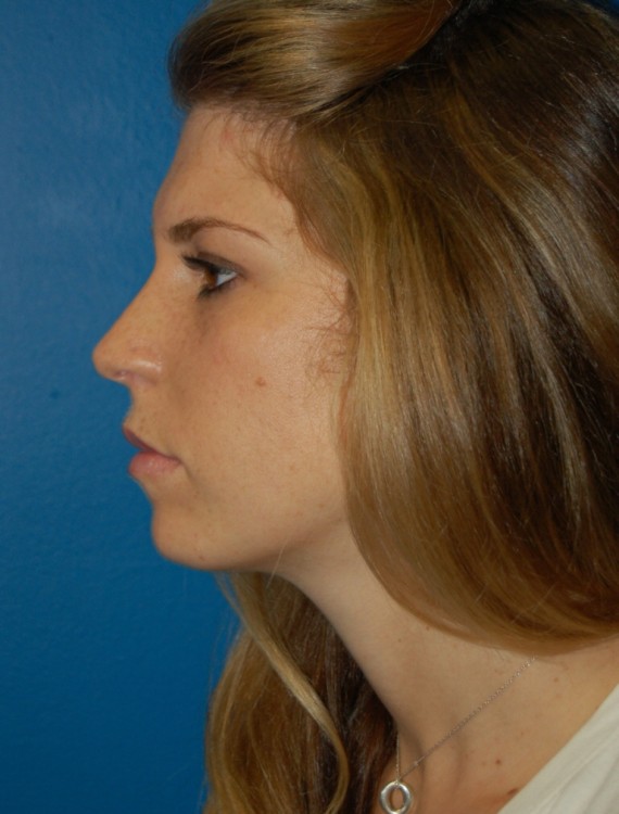 After thumbnail for Case 34 Rhinoplasty Before and After Photos