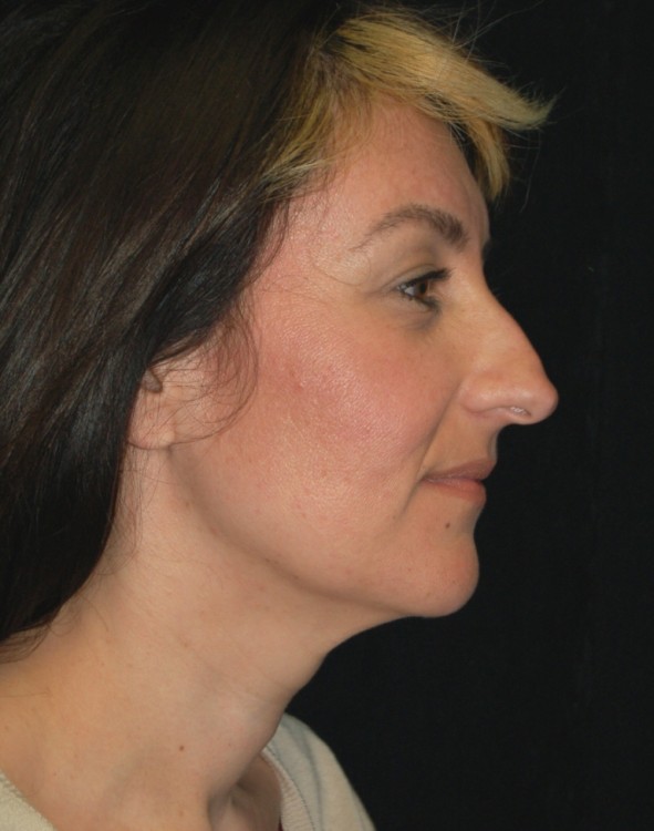 Before thumbnail for Case 38 Rhinoplasty Before and After Photos
