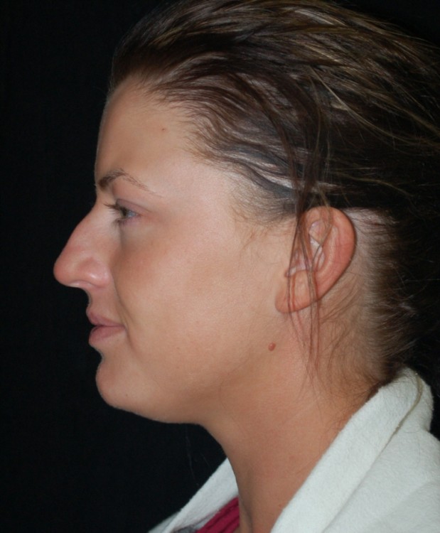 Before thumbnail for Case 40 Rhinoplasty Before and After Photos