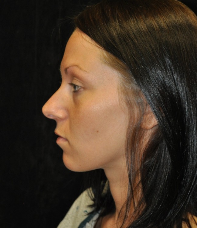 Before thumbnail for Case 41 Rhinoplasty Before and After Photos