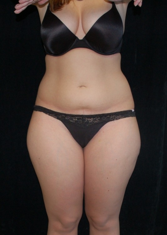 Another before picture for Case 2 Liposuction Before and After Photos