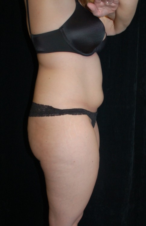 Before thumbnail for Case 2 Liposuction Before and After Photos