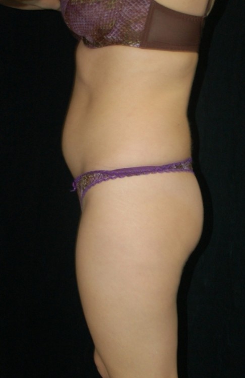 Before thumbnail for Case 3 Liposuction Before and After Photos