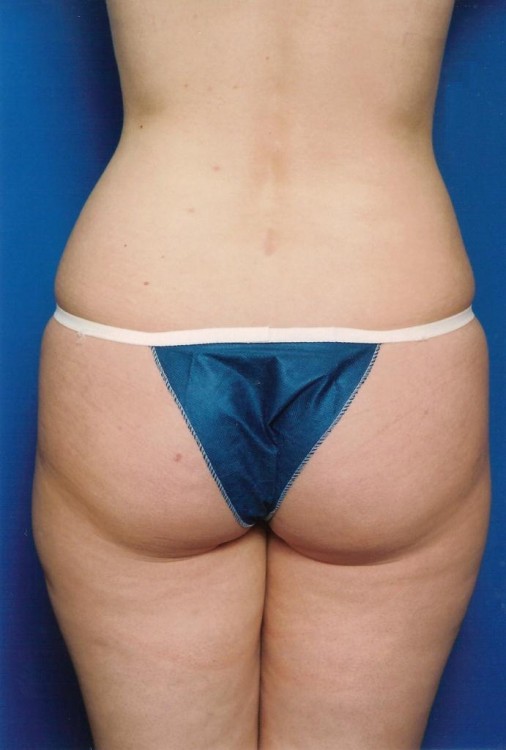 Another before picture for Case 4 Liposuction Before and After Photos