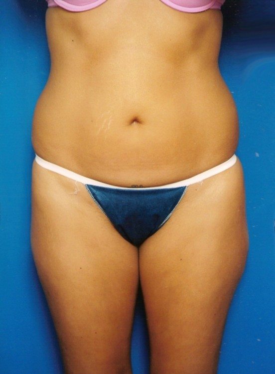 Before thumbnail for Case 6 Liposuction Before and After Photos