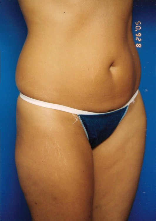 Before thumbnail for Case 6 Liposuction Before and After Photos