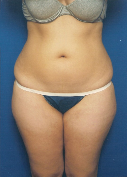 Before thumbnail for Case 9 Liposuction Before and After Photos