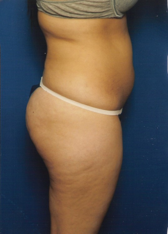 Before thumbnail for Case 9 Liposuction Before and After Photos