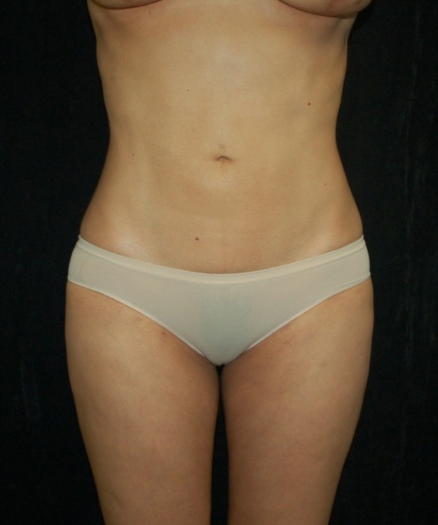 After thumbnail for Case 11 Liposuction Before and After Photos