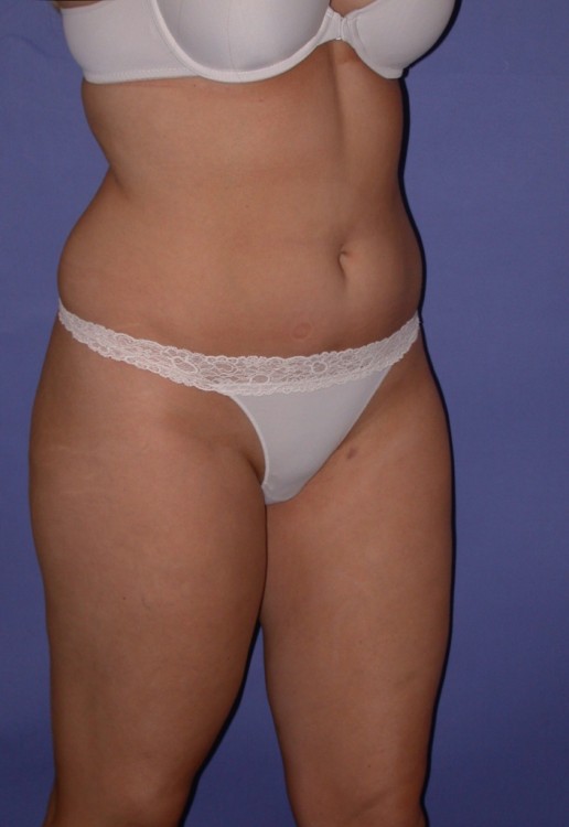 Before thumbnail for Case 15 Liposuction Before and After Photos