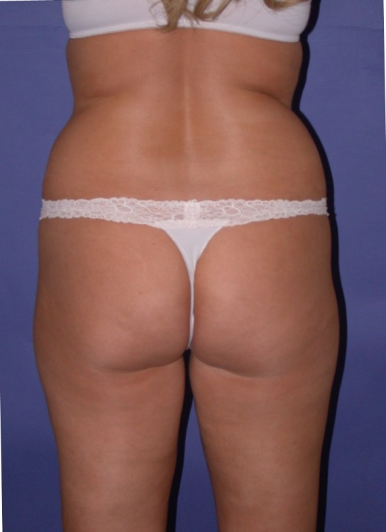 Before thumbnail for Case 15 Liposuction Before and After Photos