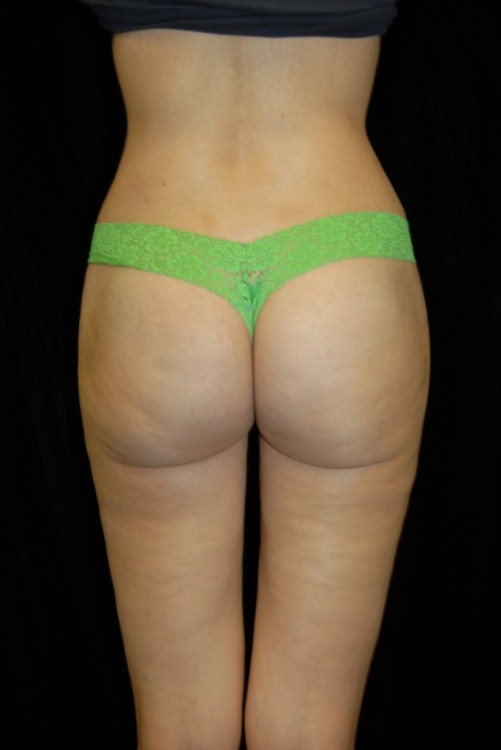 After thumbnail for Case 16 Liposuction Before and After Photos