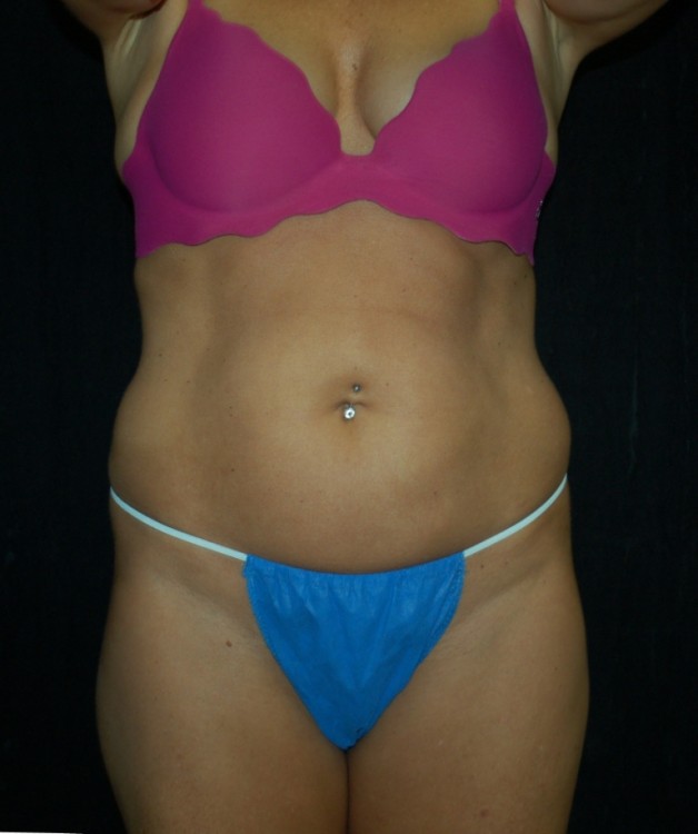 Before thumbnail for Case 17 Liposuction Before and After Photos