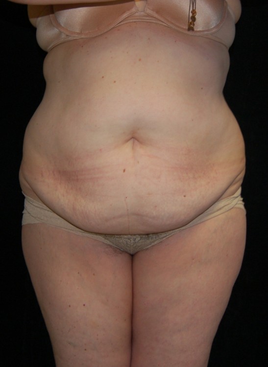 Before thumbnail for Case 8 Tummy Tuck Before and After Photos