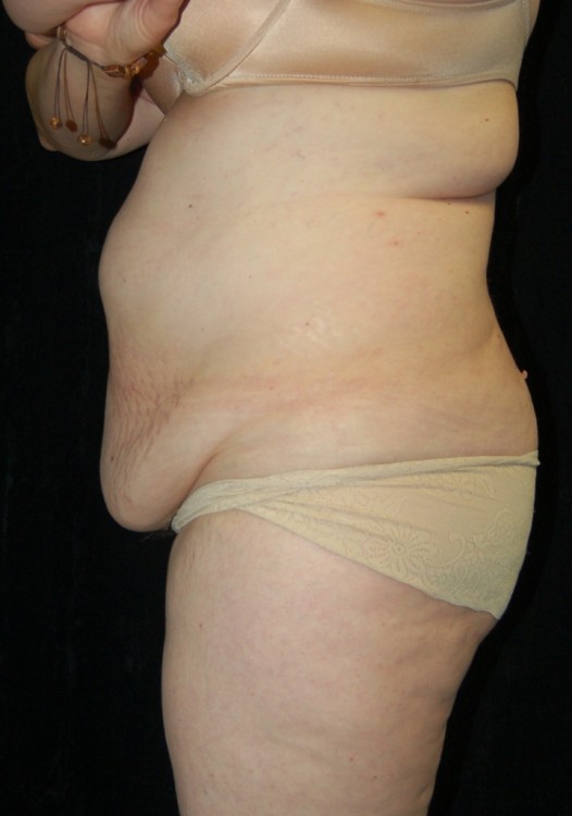 Before thumbnail for Case 8 Tummy Tuck Before and After Photos