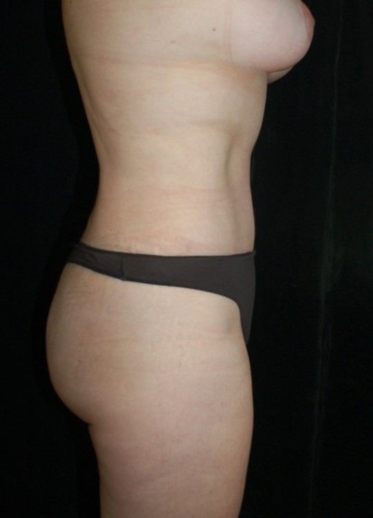 After thumbnail for Case 12 Tummy Tuck Before and After Photos