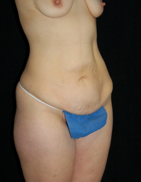Before thumbnail for Case 15 Tummy Tuck Before and After Photos